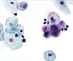 In premenopausal women, the transformation zone is fully located on the ectocervix. Cytopathology Glowm