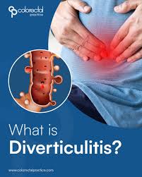 Image result for Diverticulitis