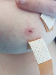 Loch In Brust Mit Eiter November 2019 Babyclub Babycenter