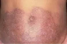 Will Sanitizers Help Cure Ringworm Why Or Why Not Quora