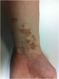 Tiny blood vessels (capillaries) link the smallest parts of your arteries to the smallest parts of your veins. The Rash That Becomes Purpuric Petechial Hemorrhagic Or Ecchymotic Sciencedirect