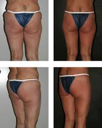 Before & after photos procedure reviews doctor q&a start your review. Build A Butt Exercises For Women The Trick To Transforming Your Butt