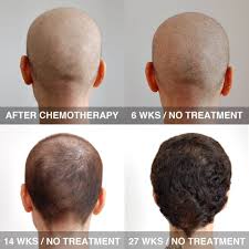 Maybe you would like to learn more about one of these? Accelerate Hair Growth After Chemo London Laser