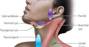 Neck Swellings Bmj Lymphatic Massage Dermoid Cyst Thyroid Neck