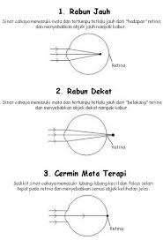 Sering kali gangguan penglihatan miopi ini mulai dirasakan sejak masa. Rabun Dekat In English