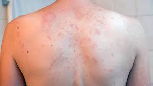 Image result for sweat rash on back