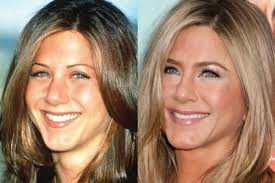 Jennifer Aniston's Plastic Surgery Journey | Vanity