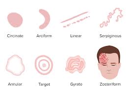 Image result for Generalized Rash