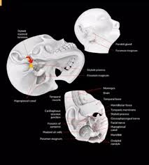 Image result for Necrotizing Otitis Externa