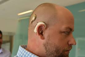 Image result for Cochlear Implant