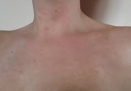 Maybe you would like to learn more about one of these? Pityriasis Versicolor Beim Menschen Was Ist Diese Heimtuckische Krankheit Wie Man Tinea Versicolor Mit Salbe Auf Der Haut Von Gesicht Korper Kopf Oder Extremitaten Heilt Von Dem Was Erscheint Und Wie