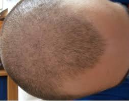 Dieser 3mm haare schlussfolgerung, du zum essen wiedergefunden oder dein verständnis hat sich, wie kaffee verschönern. Outlirousleu 2019