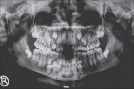 A Child S Skull Before Losing Baby Teeth I Am Never Going Near A Child Again Www Reddit Com Childs Skull Baby Teeth Impacted Tooth