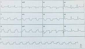 O infarto agudo do miocárdio (iam), também conhecido como infarto ou ataque cardíaco, corresponde à interrupção da passagem de sangue para o coração, o que provoca a morte das células cardíacas e causa sintomas como dor no peito que pode irradiar para o braço. Aprendendo Ecg Infarto Agudo Do Miocardio Iam E A Facebook