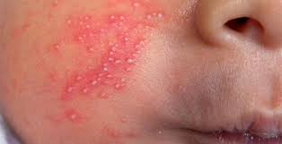 Cold sores are highly contagious. Skin Rash With Pustules On A Newborn Page 2 Of 2 Journal Of Urgent Care Medicine