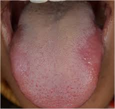 Image result for lichen planus on tongue)
