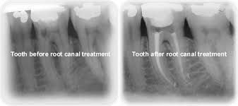 It can also protect the tooth from future. Root Canal Treatments Hitchin Dental Centre Dentist Implant Cosmetic Dentistry Prosthodontist Specialist Herts Private Endodontist Endodontics Root Canal Periodontics Veneers