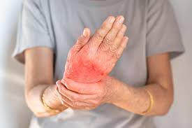 Image result for gout