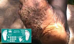 And lillian muli took the time from her busy schedule to help treat guys suffering from the blight. Jigger Fleas Burrow So Deep That Victims Must Have Them Cut Out Of Their Skin Daily Mail Online