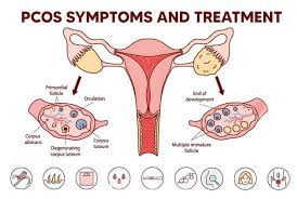 PCOS and hormonal imbalance treatment