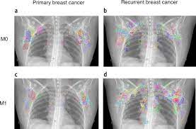 A breast positron emission tomography (pet) scan is an imaging test that uses a radioactive substance (called a tracer) to look for breast cancer. Fdg Pet Ct Based Lymph Node Atlas In Breast Cancer Patients International Journal Of Radiation Oncology Biology Physics