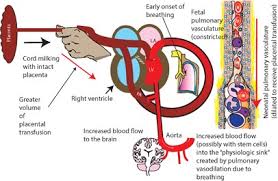 Image result for Delayed Transition from Fetal Circulation