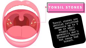 Image result for Tonsillolith
