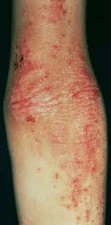 Maybe you would like to learn more about one of these? Atopisches Ekzem Und Klinische Sonderformen Springerlink