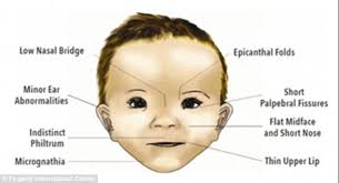 The epicanthic fold produces the eye shape characteristic of persons from central and eastern asia; Foetal Alcohol Spectrum Disorder The Facts Cassiobury Court