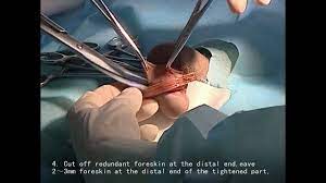 The Shang Ring Male Circumcision Non Flip Circumcision Surgery With Topical Anesthesia Youtube