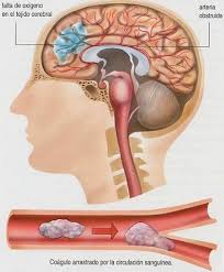 Encefalitis por virus del herpes simple: Encefalitis Causas Y Prevencion Blog De Farmacia