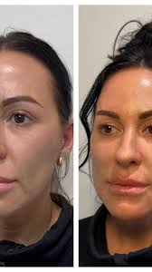 Every face tells a story and every treatment should honor it. 💫 Before any  injection, we take the time to understand your movement, your expressions,  and your goals. It's not about freezing