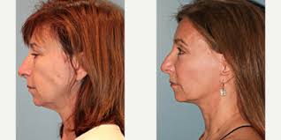 Larry S. Nichter, MD, MS, FACS, Board Certified Plastic Surgeon