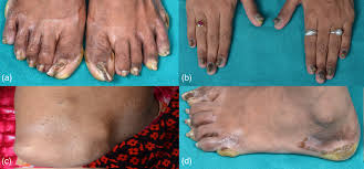 Image result for Onychogryphosis feet