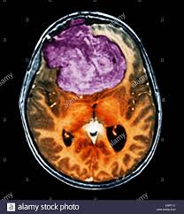 Gutartiger Hirntumor Farbige Computertomographie Ct Untersuchung Des Gehirns Eine 25 Jahrige Patientin Mit Einem Meningeom Lila Dies Ist Ein Gutartig Nicht Krebsartige Tumor Der Aus Der Hirnhaut Entsteht Die Membranen Die Das
