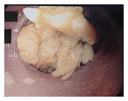 This will allow the medicine to wear off. New And Safe Treatment Of Food Impacted In The Esophagus A Single Center Experience Of 100 Consecutive Cases