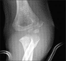 Image result for Lateral Condyle Fracture