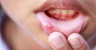 Canker Sores