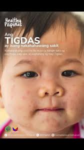 Pwede Ba Paliguan Ang May Tigdas Hangin