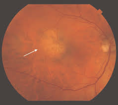 Image result for nevus sclerae