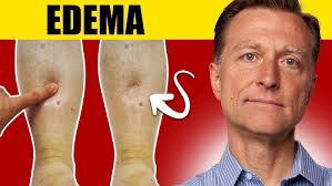 Image result for Edema
