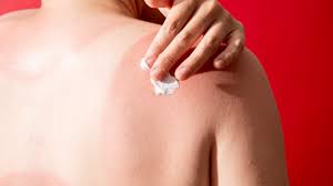 Image result for Sunburn