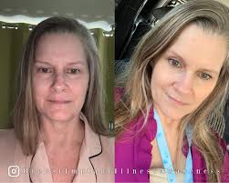 Breast implant removal experience