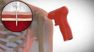 Image result for Intraosseous Access