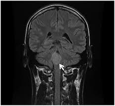 Image result for Progressive Bulbar Paralysis