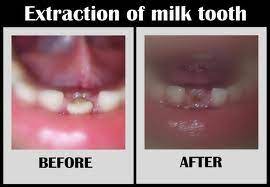 Extraction Of Baby Teeth Intelligent Dental