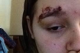 If there is pain, redness, fever or discharge form your incision, you need to get in to see your ort. How Do I Get Surgical Glue Out Of My Eyebrow Photo