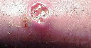Staphylococcus aureus (staph) is a type of bacteria. Deadly Skin Infection 12 Graphic Photos That Could Save Your Life Cbs News