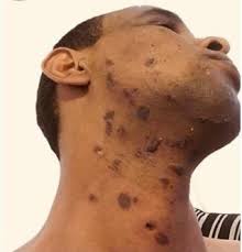 Electrolysis can be used as a treatment procedure on its own or as a follow up to laser hair removal. Claims After Botched Laser Hair Removal Procedures Double Says Lawyer Asian Image
