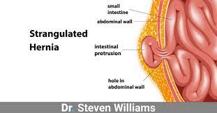 I said it's causin' me such irritation living with a hernia have to have my medication living with a hernia i feel bad! When It S Time For Hernia Surgery Dr Steven Williams In Boise